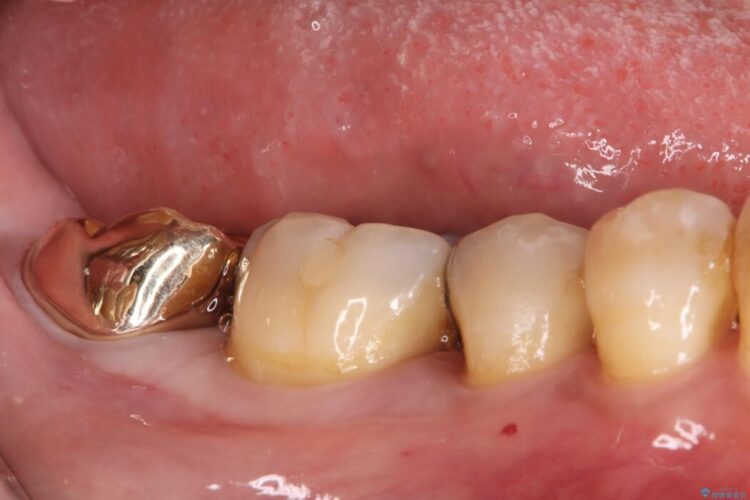 欠けた奥歯をPGAで補強。違和感のない咬み心地へ 治療後画像