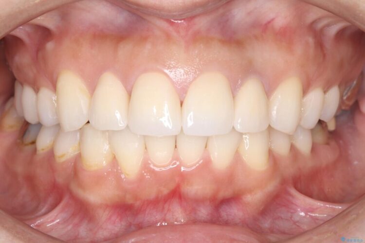 欠けて変色した前歯をオールセラミックで美しく 治療後画像