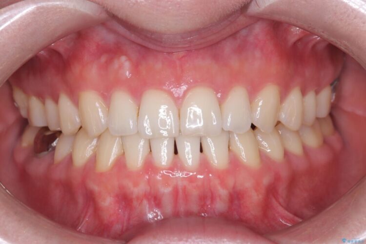 すきっ歯・切端咬合・空隙歯列をインビザラインで短期間矯正 アフター