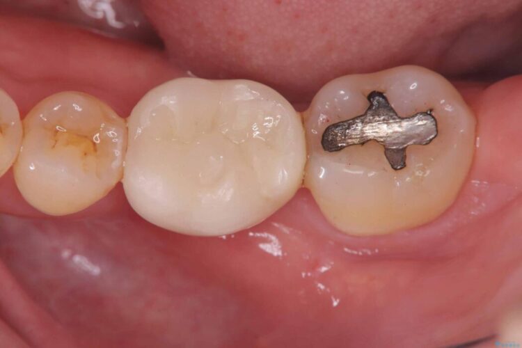 根尖性歯周炎|分岐部病変|パーフォレーション|インプラント治療で改善 アフター