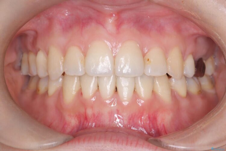 ワイヤー矯正で口元を下げたい、下の歯の凹凸を無くしたい 治療後画像