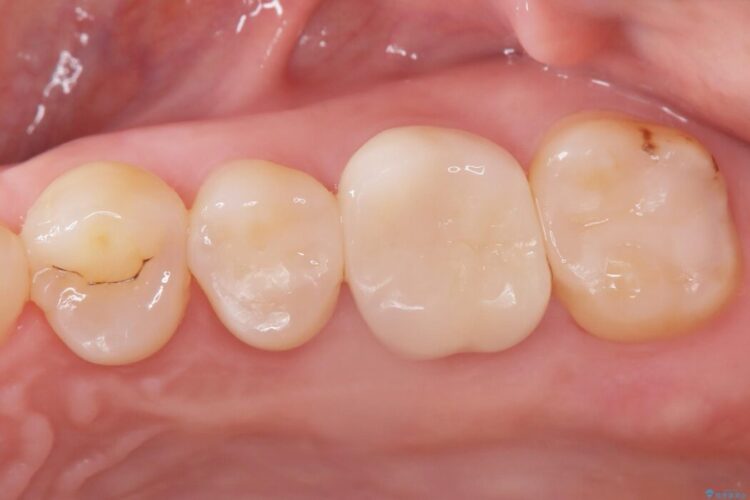 2回の来院で完了！奥歯のセラミック修復 アフター