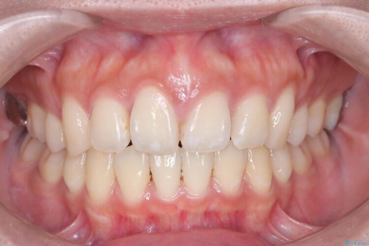 ワイヤー矯正で口元の突出感を改善!横顔を美しく 治療後画像