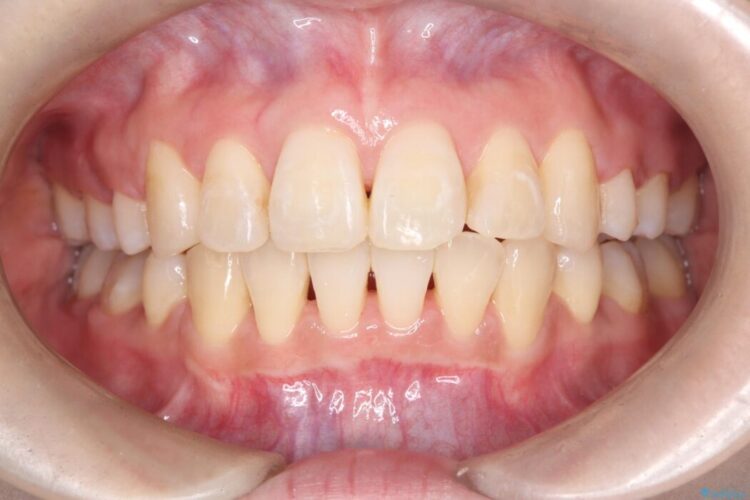 ワイヤー矯正で八重歯と正中のズレを解消 アフター