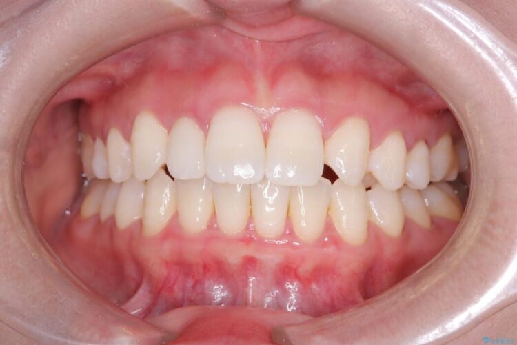 軽度の叢生|わずか5か月の短期間矯正 治療後画像