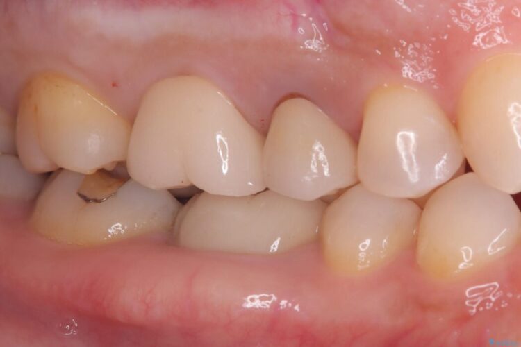 奥歯の銀歯を白い歯に！歯の破折を防ぐセラミッククラウン アフター
