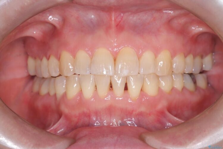 1年で完了！前歯の軽度なガタつきをワイヤー矯正で美しく 治療後画像