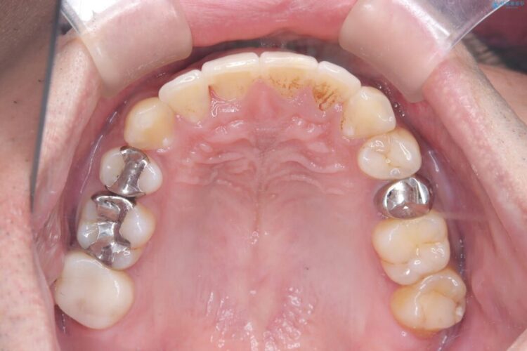 目立つ八重歯と下の歯の凸凹を治したい 治療後画像