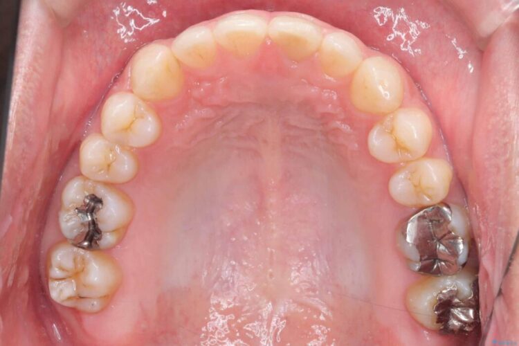 正中離開・クロスバイト・すきっ歯・叢生|インビザラインで改善 治療後画像