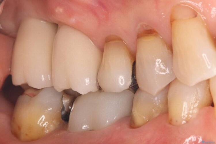 重度歯周病で失った2本の奥歯を1DAYインプラント治療 治療後画像