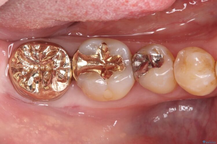 欠けた奥歯をPGAで補強。違和感のない咬み心地へ 治療後画像