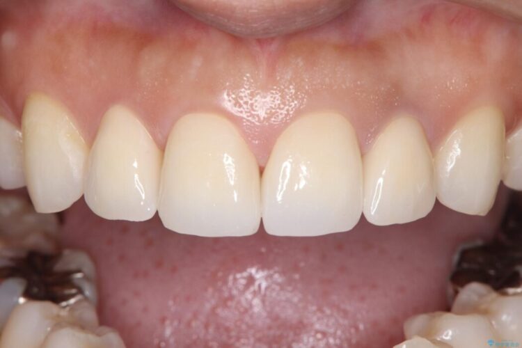 欠けて変色した前歯をオールセラミックで美しく 治療後画像