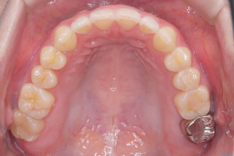 すきっ歯・切端咬合・空隙歯列をインビザラインで短期間矯正 治療後画像