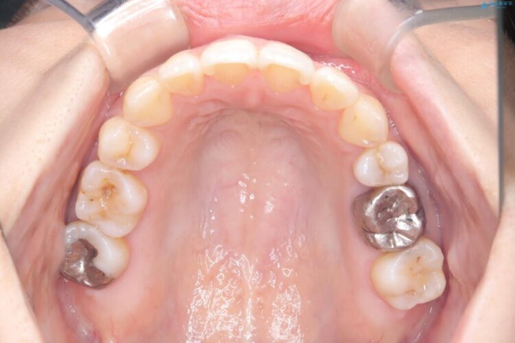 ワイヤー矯正で口元を下げたい、下の歯の凹凸を無くしたい 治療後画像