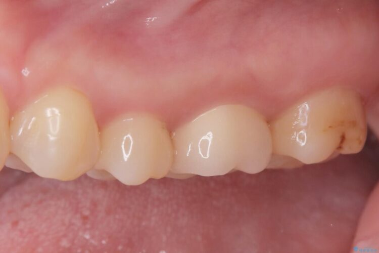 2回の来院で完了！奥歯のセラミック修復 治療後画像