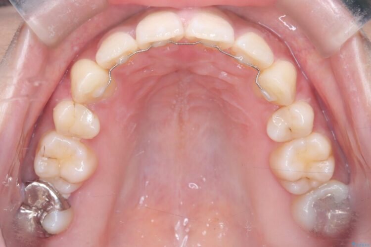 ワイヤー矯正で口元の突出感を改善!横顔を美しく 治療後画像