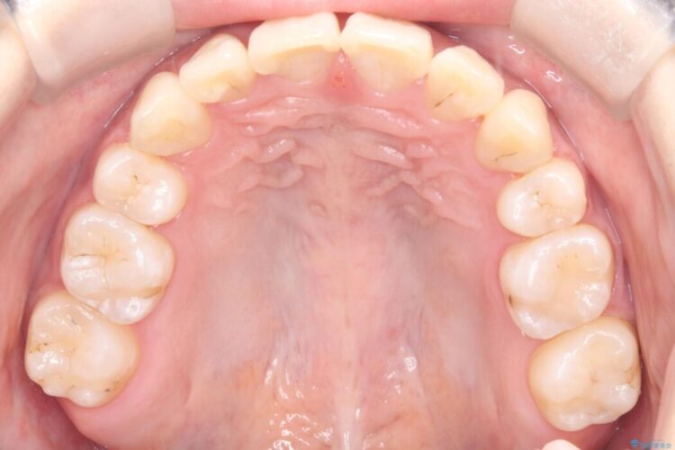 ワイヤー矯正で八重歯と正中のズレを解消 治療後画像