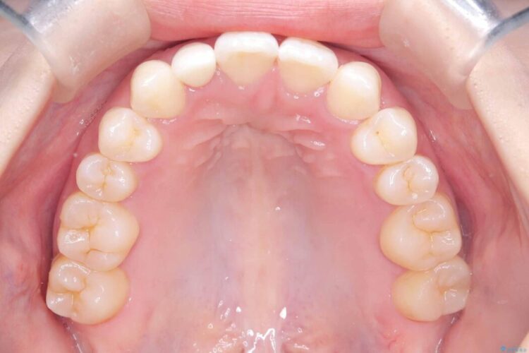 軽度の叢生|わずか5か月の短期間矯正 治療後画像