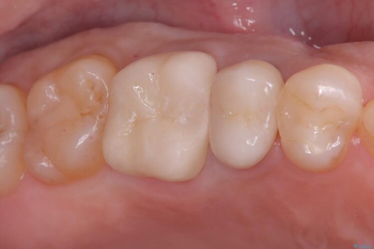 奥歯の銀歯を白い歯に!歯の破折を防ぐセラミッククラウン 治療後画像