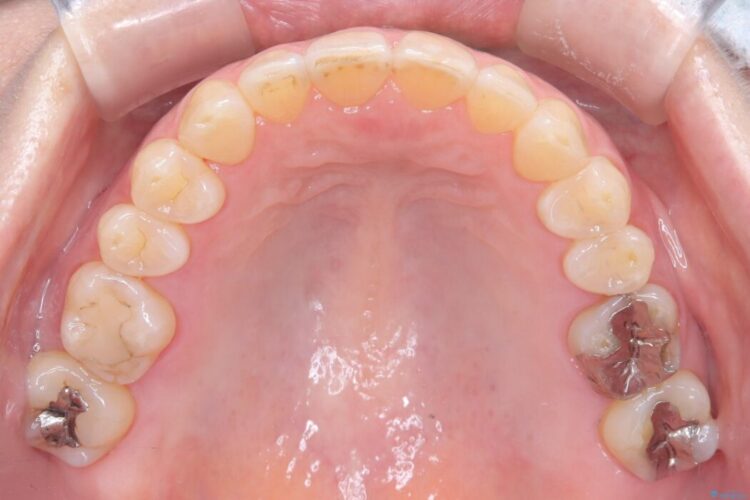 1年で完了！前歯の軽度なガタつきをワイヤー矯正で美しく 治療後画像