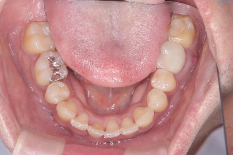 目立つ八重歯と下の歯の凸凹を治したい 治療後画像