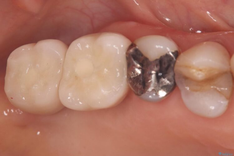 重度歯周病で失った2本の奥歯を1DAYインプラント治療 治療後画像