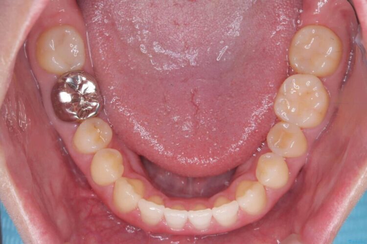 すきっ歯・切端咬合・空隙歯列をインビザラインで短期間矯正 治療後画像