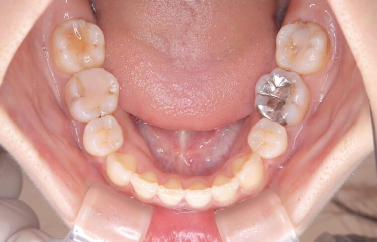 ワイヤー矯正で口元を下げたい、下の歯の凹凸を無くしたい 治療後画像