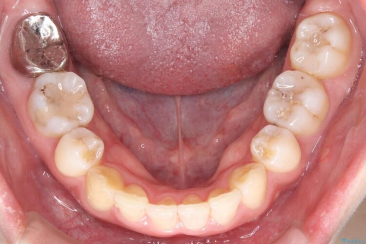 重度の歯のがたつきをインビザラインで改善 治療後画像