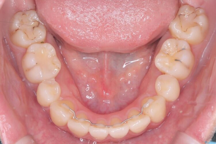 ワイヤー矯正で口元の突出感を改善!横顔を美しく 治療後画像