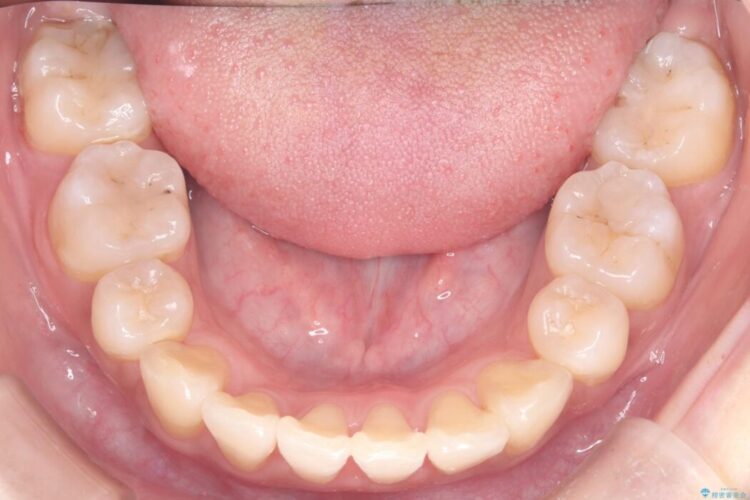 ワイヤー矯正で八重歯と正中のズレを解消 治療後画像