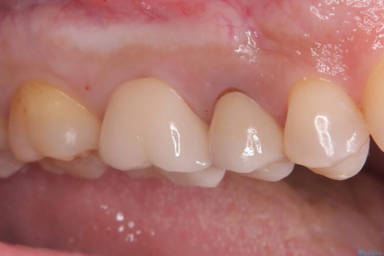 奥歯の銀歯を白い歯に!歯の破折を防ぐセラミッククラウン 治療後画像