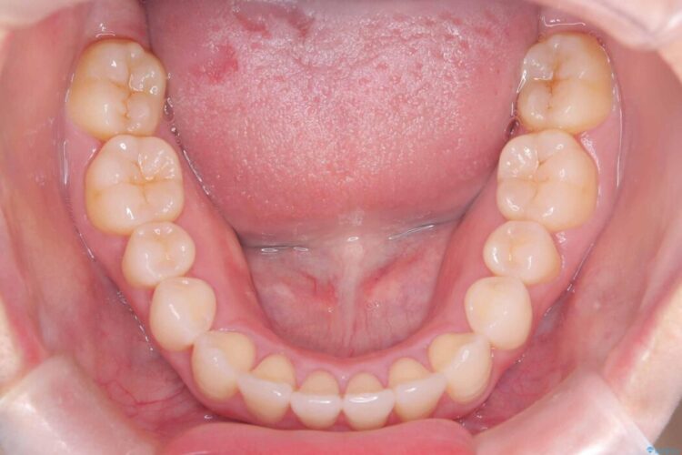 軽度の叢生|わずか5か月の短期間矯正 治療後画像