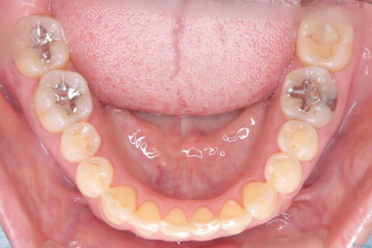 1年で完了！前歯の軽度なガタつきをワイヤー矯正で美しく 治療後画像