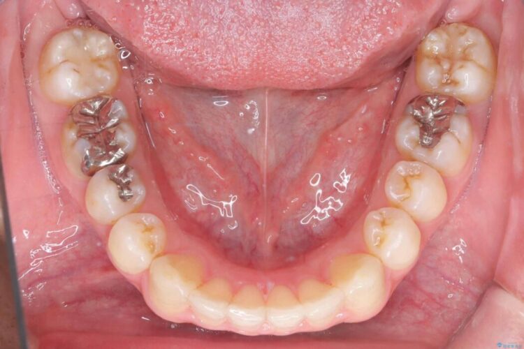 正中離開・クロスバイト・すきっ歯・叢生|インビザラインで改善 治療後画像