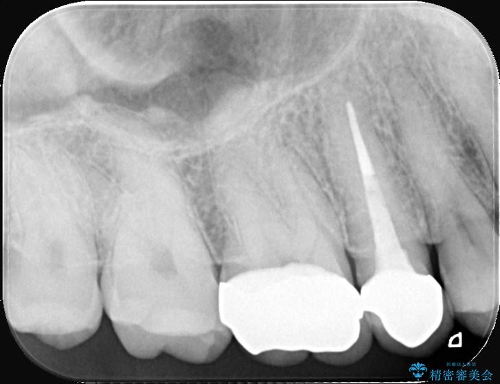 奥歯の銀歯を白い歯に!歯の破折を防ぐセラミッククラウン 治療後画像