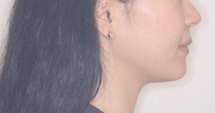 ワイヤー矯正で口元を下げたい、下の歯の凹凸を無くしたい 治療後画像