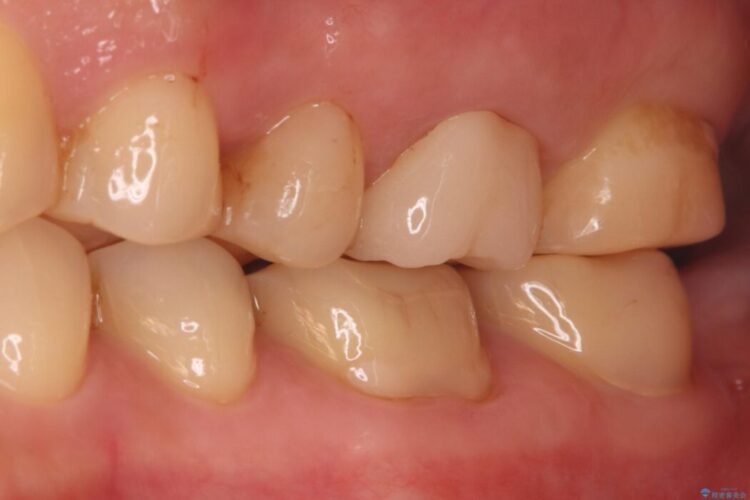 奥歯の痛みを解消！クラウンで長期的に歯を守る アフター
