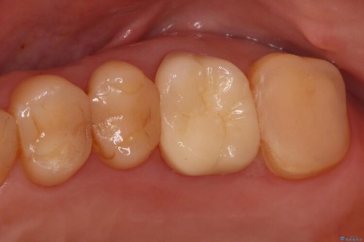 奥歯の痛みを解消!クラウンで長期的に歯を守る 治療後画像