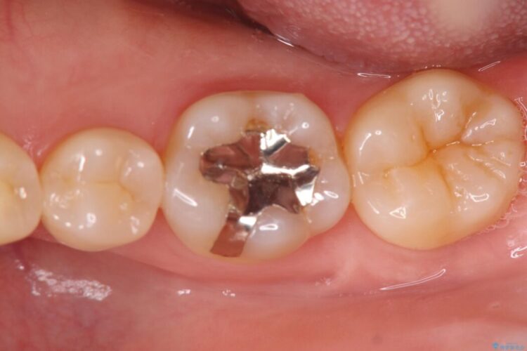 銀歯の段差の改善、ラバーダム防湿下で行うセラミックインレー治療 ビフォー