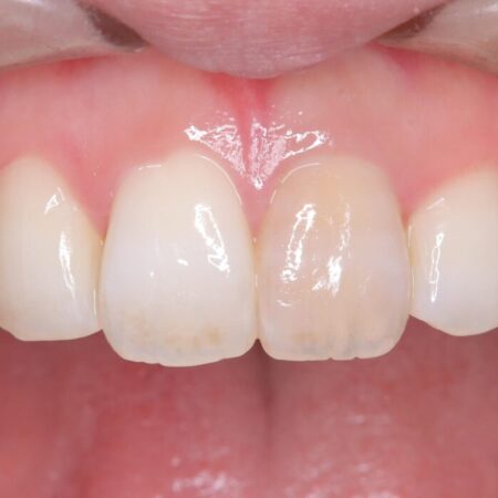 再根管治療とオールセラミックで前歯の気になる変色を解消 治療前