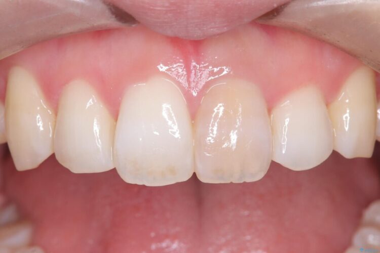 再根管治療とオールセラミックで前歯の気になる変色を解消 ビフォー