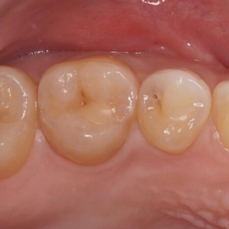自然な見た目のセラミックインレーで精密に修復 治療前