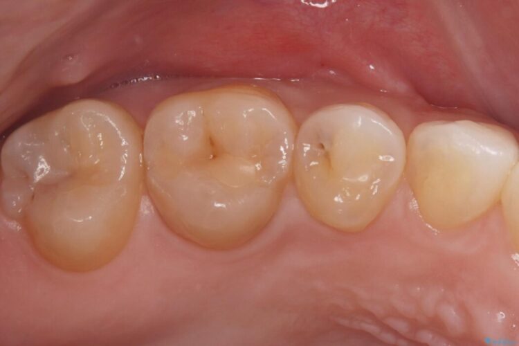 自然な見た目のセラミックインレーで精密に修復 ビフォー