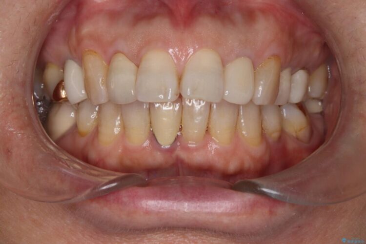 セラミックやり替え前のオフィスホワイトニング ビフォー