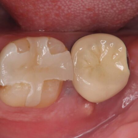1DAYインプラント|歯根嚢胞と瘻孔を伴う奥歯の治療 治療前
