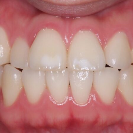 着色や黄ばみが気になる歯、オフィスホワイトニング 治療前