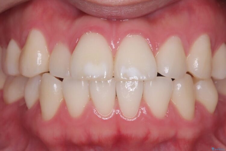 着色や黄ばみが気になる歯、オフィスホワイトニング ビフォー