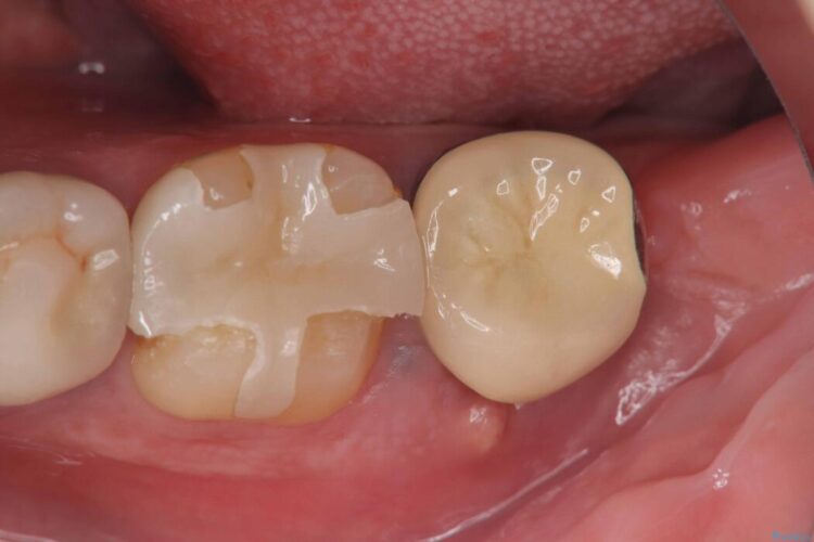 1DAYインプラント|歯根嚢胞と瘻孔を伴う奥歯の治療 ビフォー