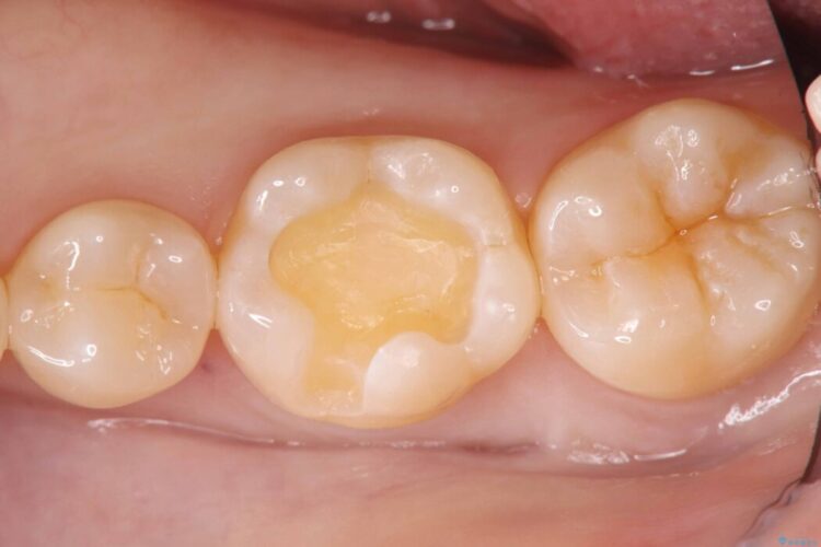 銀歯の段差の改善、ラバーダム防湿下で行うセラミックインレー治療 治療途中画像